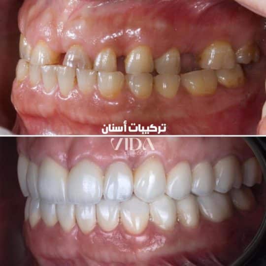حالات اسنان قبل وبعد