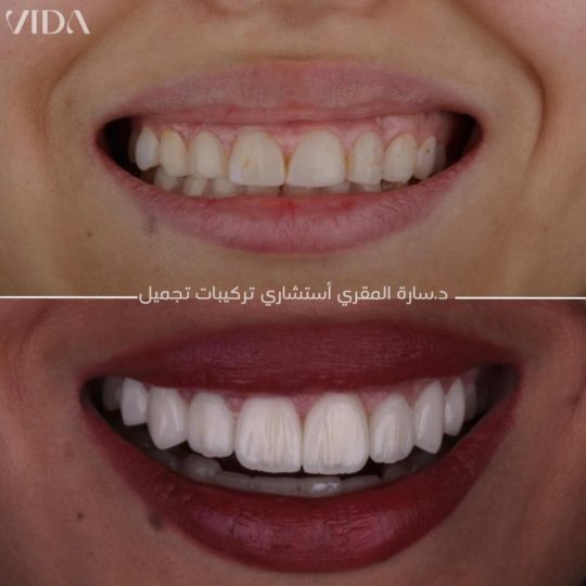 حالات اسنان قبل وبعد