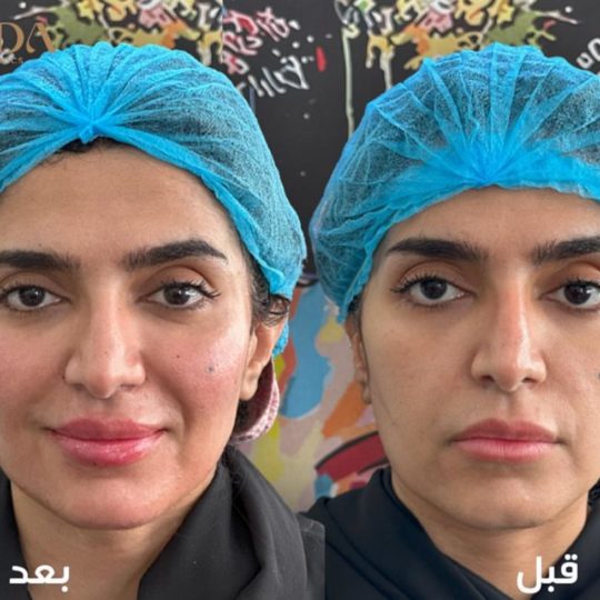 حالات تجميل قبل وبعد