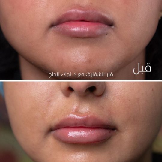 حالات تجميل قبل وبعد