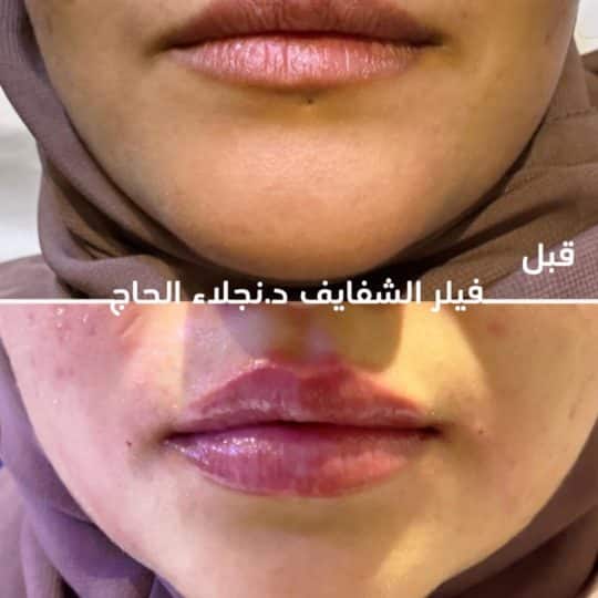 حالات تجميل قبل وبعد