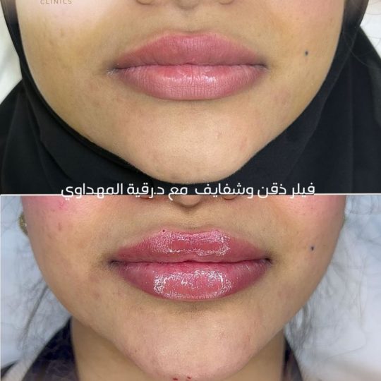 حالات تجميل قبل وبعد